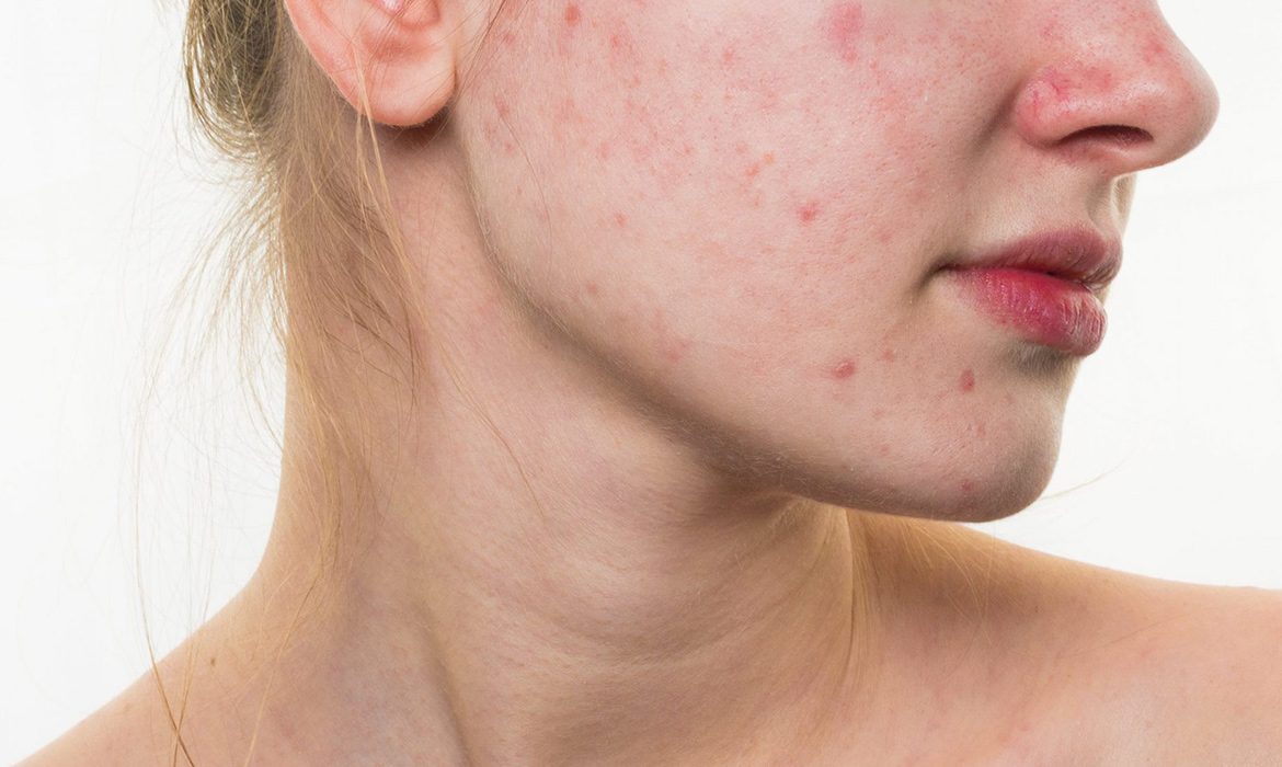 The Most Effective Ingredients and Product Recommendations for Acne and Pimples